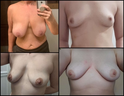 breast-blog_0005