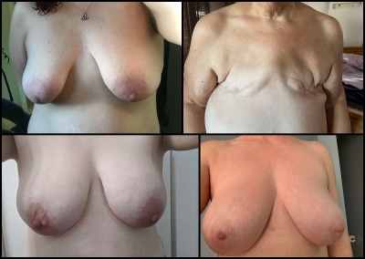 breast-blog_0010